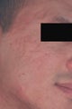 Laser Resurfacing for Acne Scars