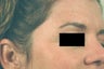 Crow's feet treatment