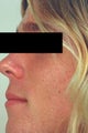 Laser Resurfacing for Enlarged Pores