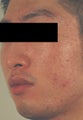 Laser Resurfacing 