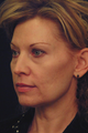 Yag Laser Skin Tightening