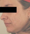 Acne Scar Removal 