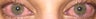 Laser Eye Surgery