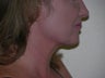 Laser liposuction
