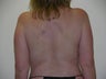 Laser liposuction