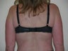 Laser liposuction