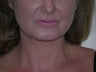 Laser liposuction