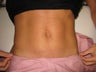 Laser Liposuction and Mini Tummy Tuck 