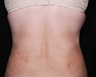 Laser Liposuction