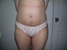 Laserlipolysis