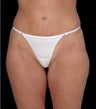 Laser Liposuction