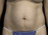 Laser liposuction