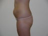 Liposuction