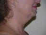 Laser liposuction