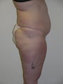 Laser liposuction