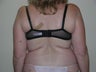 Laser liposuction