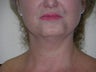 Laser liposuction
