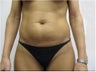 Laser Liposuction and Mini Tummy Tuck 