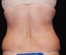 Laser Liposuction