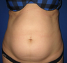 Laser Liposuction