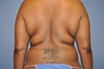 Laser Liposuction