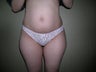 Laserlipolysis