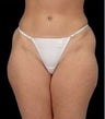 Laser Liposuction