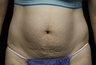 Laser liposuction