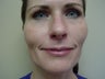 Microlaser Peels