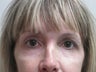 Peri Orbital Laser Resurfacing