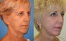 Image Lift, Full Face Laser