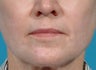 Laser resurfacing-Erbium ablative resurfacing