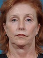 Laser resurfacing-Erbium ablative resurfacing, Face, neck and brow lift