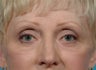 Laser resurfacing-fractional CO2