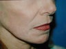 Laser Skin Resurfacing with Dr. Clevens