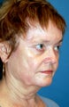 Laser Skin Resurfacing with Dr. Clevens