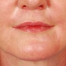 CO2 Laser Resurfacing