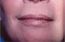 Laser Resurfacing