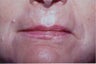 Laser Resurfacing