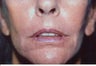 Laser Resurfacing