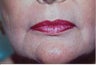 Laser Resurfacing