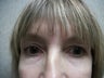 Peri Orbital Laser Resurfacing