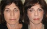 Small Image Lift, Full Face Laser Resurfacing
