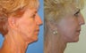 Image Lift, Full Face Laser