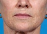 Laser resurfacing-Erbium ablative resurfacing