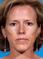 Laser resurfacing-Erbium ablative resurfacing