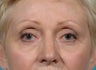 Laser resurfacing-fractional CO2