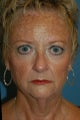 Laser Skin Resurfacing with Dr. Clevens