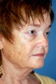 Laser Skin Resurfacing with Dr. Clevens