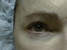 Mixto Fractionated Laser Resurfacing Treatment